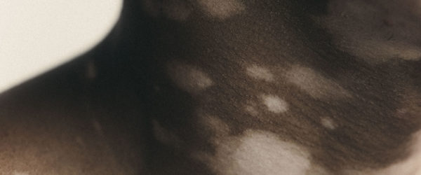 Vitiligo Portraits0223