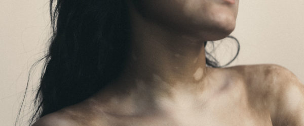Vitiligo Portraits0458